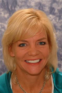 after-porcelain-veneers
