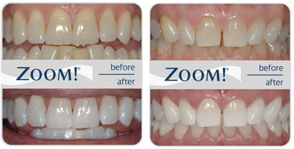 Zoom! tooth whitening results