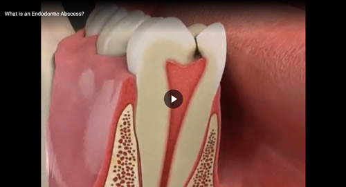 What is an Endodontic Abcess?