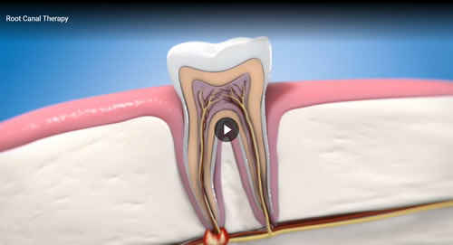 Root Canal Therapy