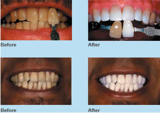 Teeth Whitening - Before and After