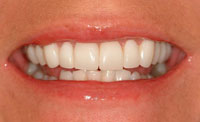 after porcelain crowns