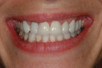 after porcelain crowns