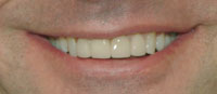 after porcelain veneers