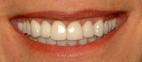 after porcelain veneers