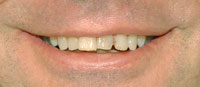 before porcelain veneers