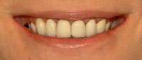 before porcelain veneers