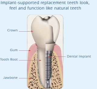 dental implant diagram
