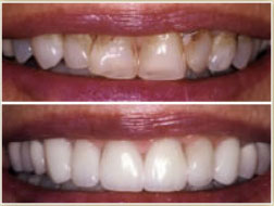 dental veneers