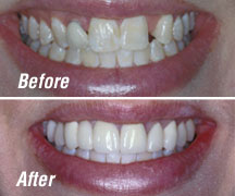 porcelain crowns porcelain crowns