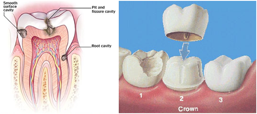 Cosmetic Dentist in Shelby Discusses Dental Crowns and Cavities