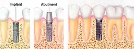 Ask the Gentle Dentist: Dental Implants