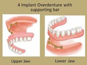 Ask the Gentle Dentist: Dental Implants