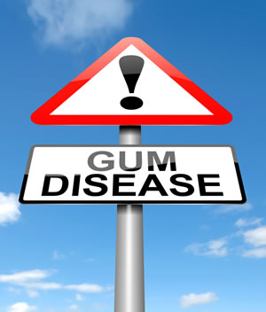 Gum Disease Treatment - Shelby Twp, MI