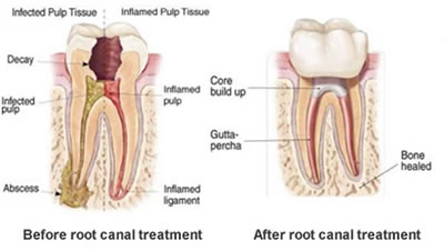 Emergency Root Canal Dentist - Shelby Twp., MI