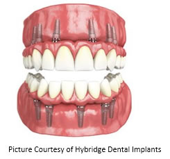 Hybridge Dental Implants