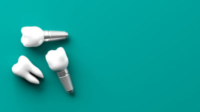 Should I Get Dental Implants - Yes or No?