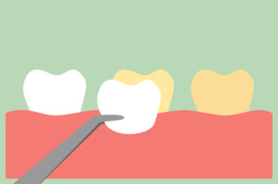 Correcting Dental Imperfections with Veneers