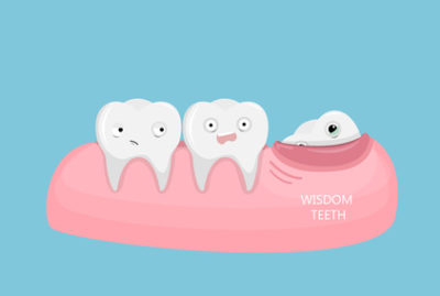 Understanding Why People Need Their Wisdom Teeth Removed