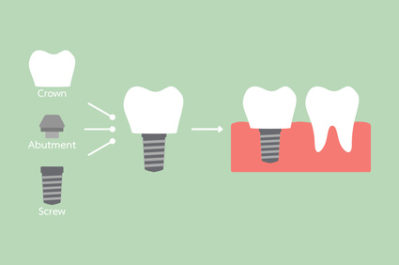 When & Why Does Someone Need Dental Implants?