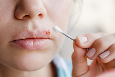 Cold Sores: A major oral herpes symptom
