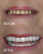 Cosmetic Dentures Before/After
