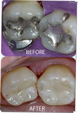 Tooth Colored FIllings